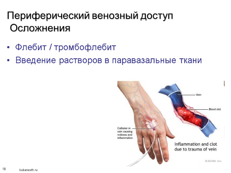 18 Периферический венозный доступ  Осложнения Флебит / тромбофлебит Введение растворов в паравазальные ткани